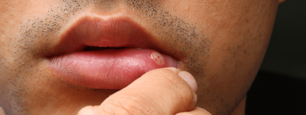Best Mouth Ulcer Treatment in Whitefield