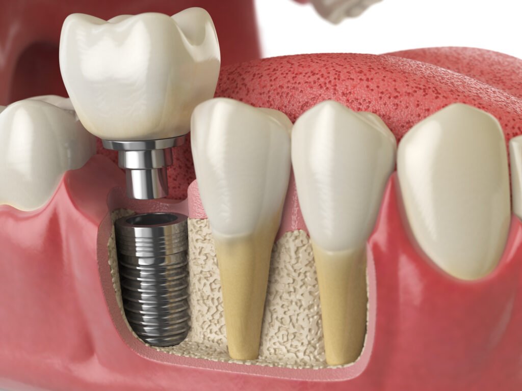 best Dental Implant in Varthur Road