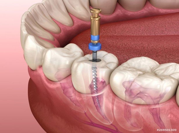 Best Root Canal Treatment in Whitefield.