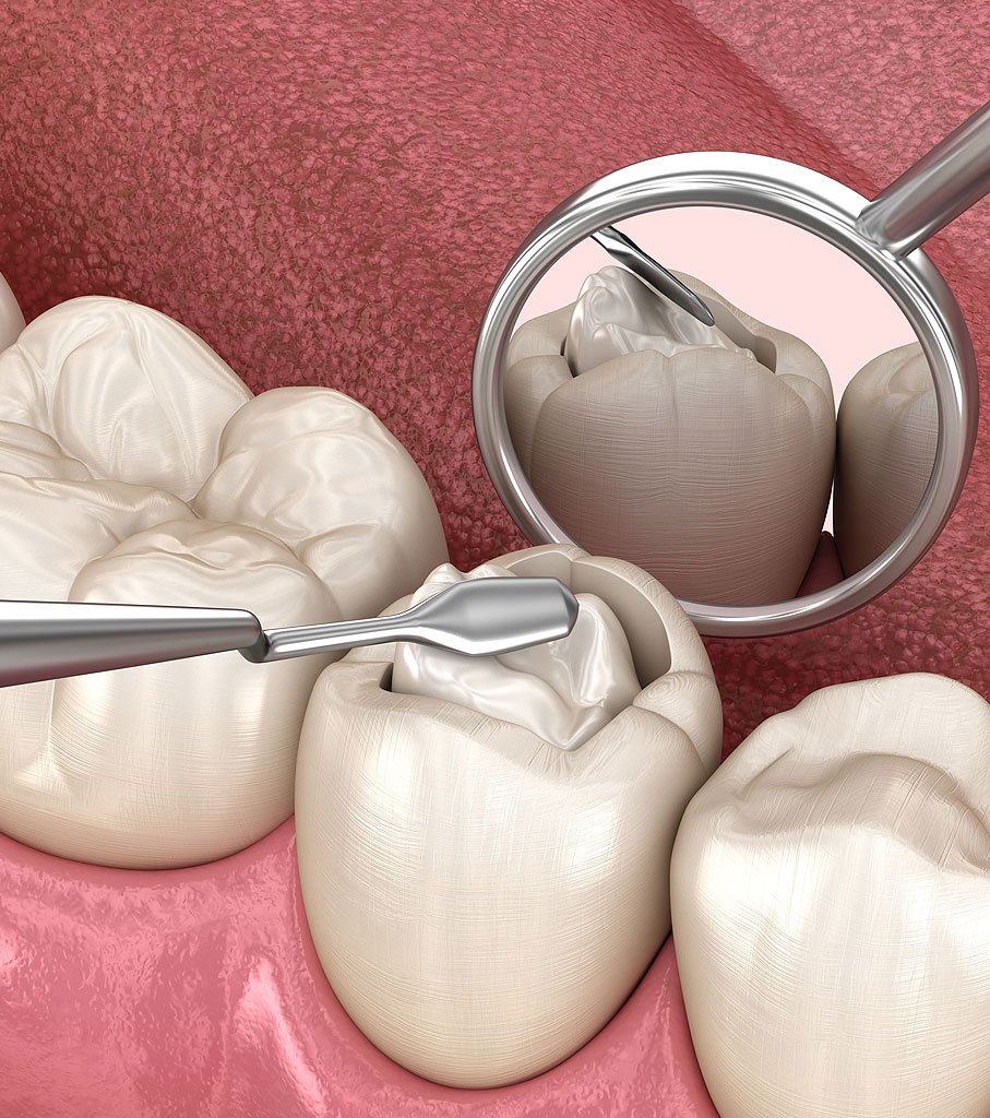 dental filling