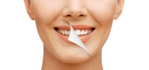 Smile Makeover